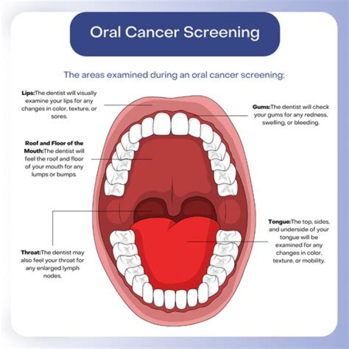 Oral Cancer Screening | Beavercreek, OH | Early Detection
